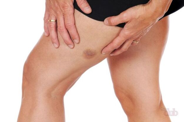 se uma veia estourar