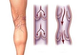 saída de sangue em veias varicosas em diferentes estágios de desenvolvimento da doença